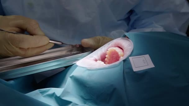 Professionelle Ärzte, die zahnärztliche Operationen durchführen und Zähne im Mund des Patienten behandeln. Operative Operation. Zahnmedizin. — Stockvideo