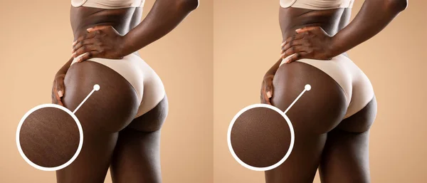Before and after treatment for cellulite and stretch marks, collage — Fotografia de Stock