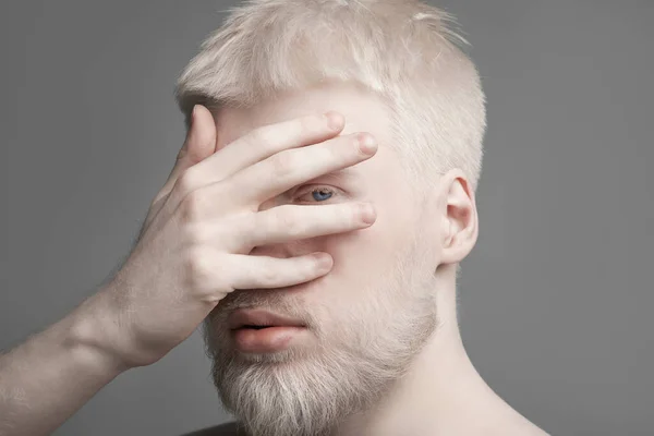 Alışılmadık albino adam yüzünü avuç içi ile kapatıyor, tek gözüyle kameraya bakıyor, gri stüdyo arka planı — Stok fotoğraf