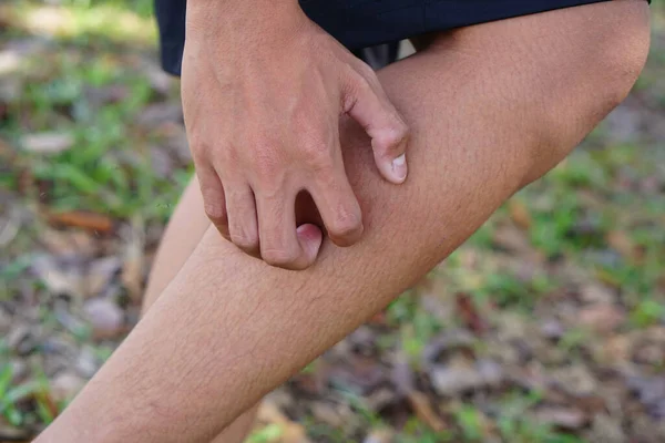Human Hands Scratching Legs Due Itching — Fotografia de Stock