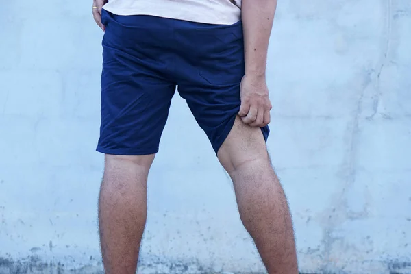 Man Scratching His Leg — Stockfoto