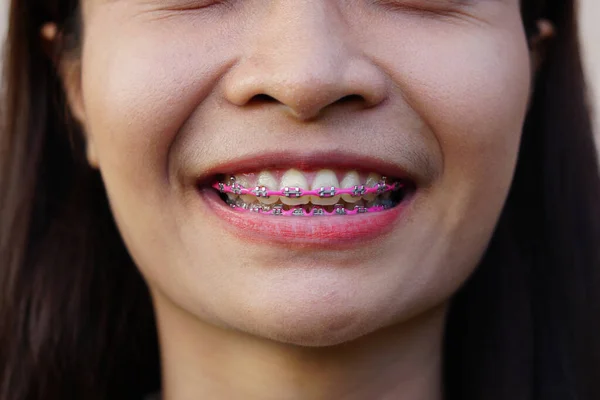 Asiatische Frauen Lächeln Mit Schönen Zahnspangen — Stockfoto