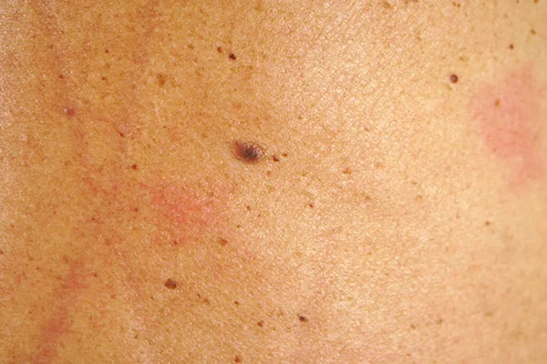 Moles Back Human Skin — Stock Photo, Image