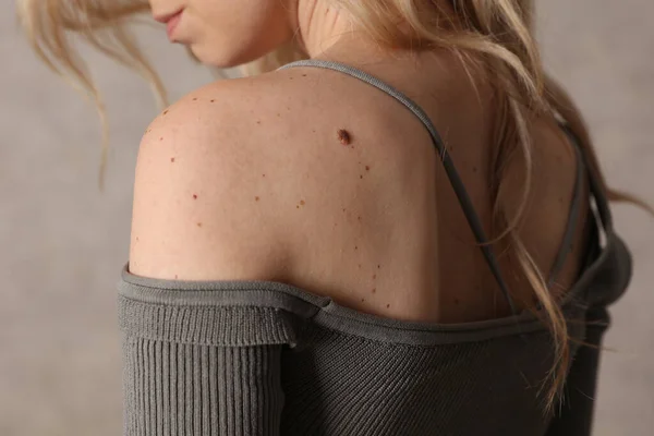 Checking Benign Moles Portrait Beautiful Woman Birth Marks Her Back —  Fotos de Stock