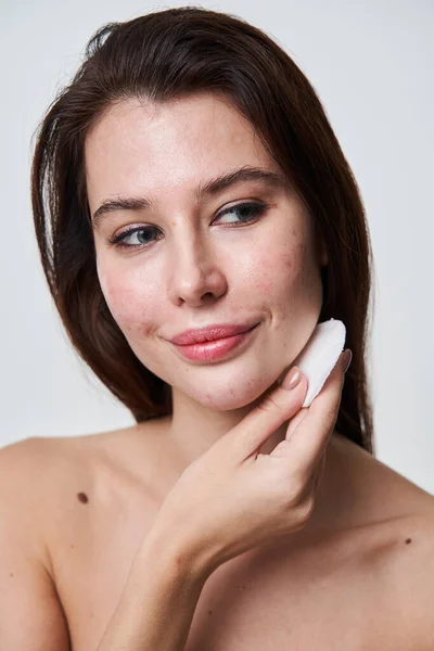Vit kvinna med huddefekter som avlägsnar smink från ansiktet — Stockfoto