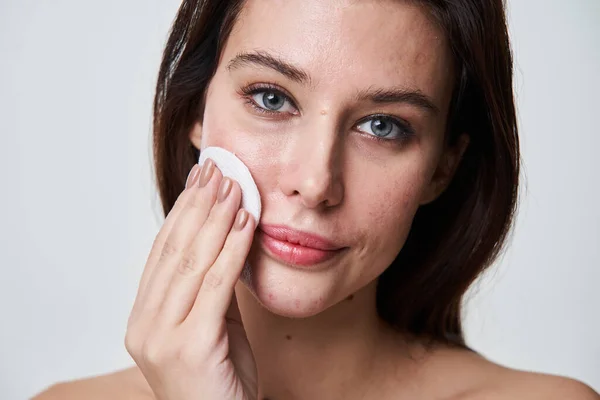 Brunette attractive woman with post acne spots cleaning her face with a cotton pad — Stock Photo, Image