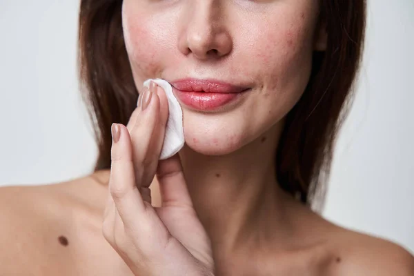 Mujer preocupación con manchas de acné en la cara y suavemente tocando mejilla — Foto de Stock