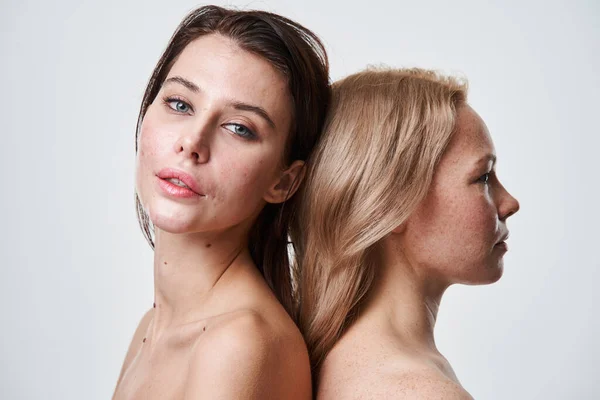 Skönhetsporträtt av europeiska flickor med bara axlar och olika hudtillstånd — Stockfoto