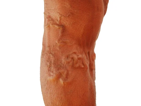 Severity Varicose Veins Ranges Tiny Capillaries Pain Legs Swollen Feet — Stock Photo, Image