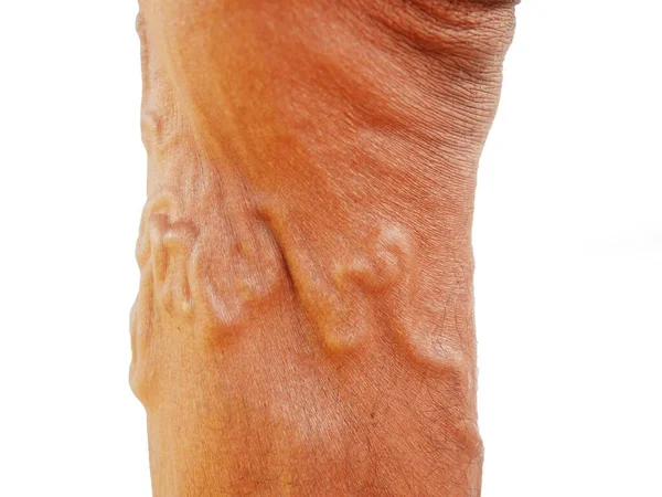 Varisli Damarların Şiddeti Küçük Kılcal Damarlar Bacaklardaki Ağrı Şişmiş Ayaklar — Stok fotoğraf