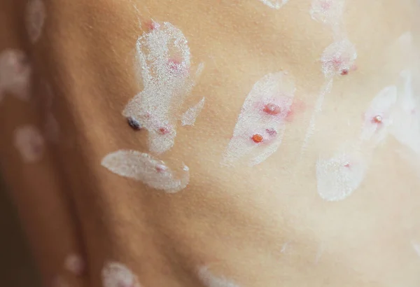 Chicken pox rash, chickenpox disease, Closeup.Consequences of chicken pox. Varicella zoster virus — Foto Stock