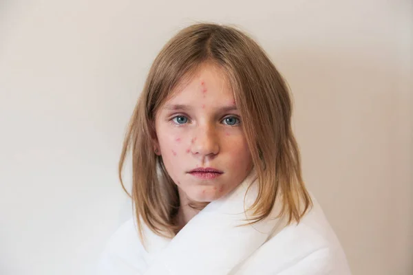 Cute little girl with chickenpox at home. Varicella zoster virus. — Stock Photo, Image