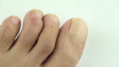 Tırnaklarda dikey çıkıntılar, vitamin eksikliği ve mineral eksikliği var. Tırnağında çizgi olan erkek el ve ayaklarının üst görünümü..