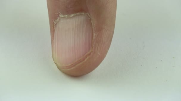 爪の症状の垂直尾根不足ビタミンやミネラル 指の爪に線で男性の手や足の上のビュー — ストック動画