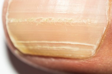 Longitudinally striped nails of hands and feet - Vertical ridges on the fingernails symptoms deficiency vitamins and minerals - Top view of male hand or feet with line on the finger nail.