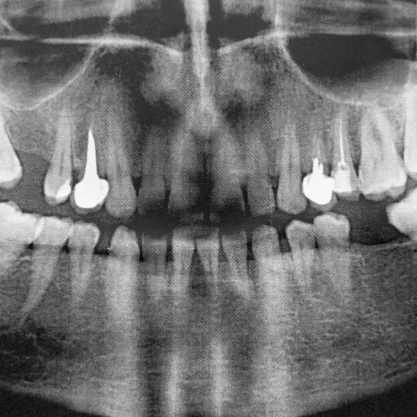 Radiographie Mâchoire Homme 360 Degrés Bruit Très Élevé Deux Implants — Photo