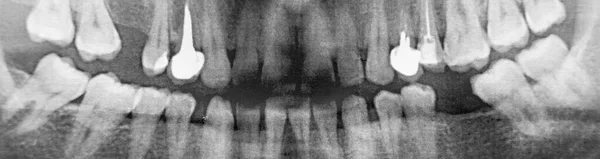 Bir Adamın Çenesinin Röntgeni 360 Derece Çok Gürültülü Iki Implant — Stok fotoğraf