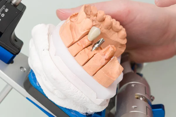 Зубной Имплантат Артикуляторе Протезное Седло Стоматологической Лаборатории — стоковое фото
