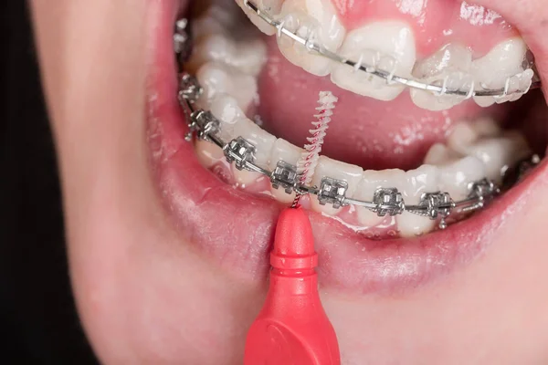 Närbild Kvinnas Eller Tonårings Mun Med Tandställning Att Rengöra Sina — Stockfoto