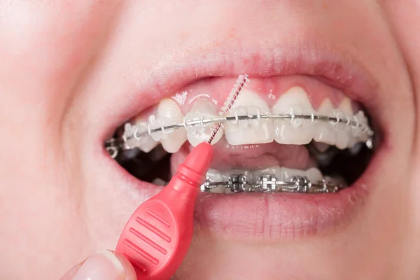 Close Woman Teenager Mouth Dental Brace Cleaning Teeth Dental Brush — Photo