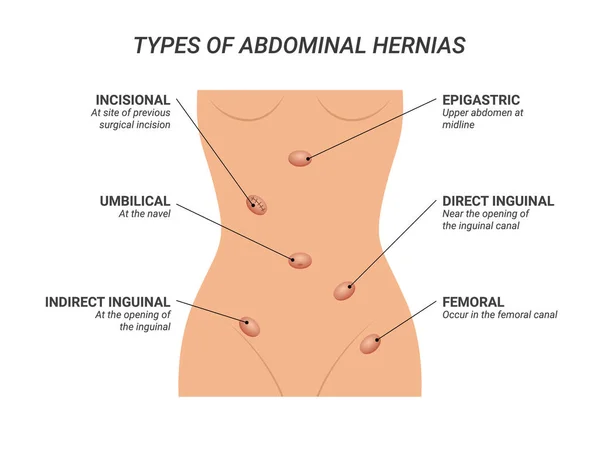 Types Abdominal Hernias Illustration Isolated Background — Archivo Imágenes Vectoriales