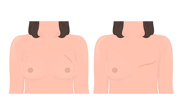 Mastectomy Breast Cancer Lymph Node Surgery — Vector de stock