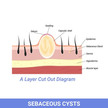 Sebaceous Cyst or other skin and follicle problems illustration clipart
