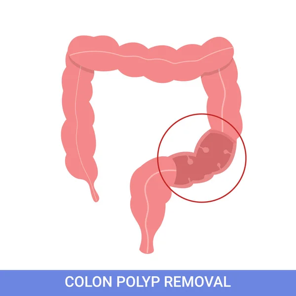 Colonoscopy Intestine Polypectomy Procedure Removal Polyp Colon Colon Surgery — Stock Vector