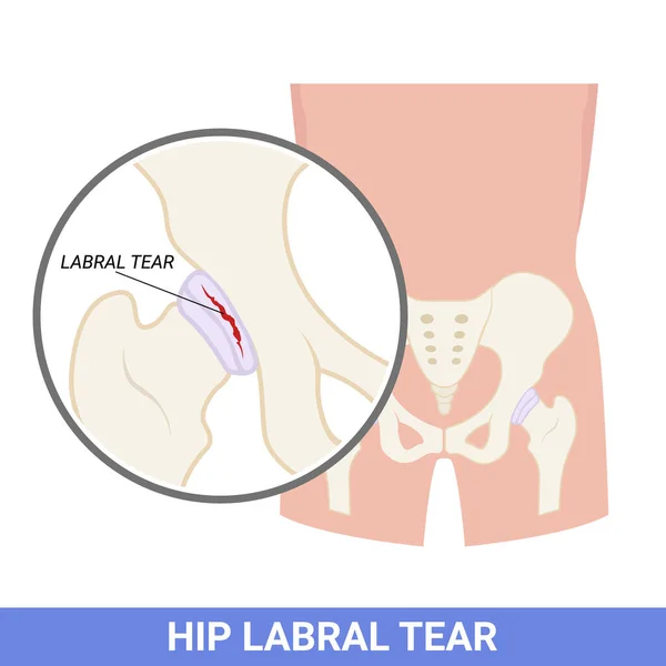 Labral Hip Tear Injury Disorder Medical —  Vetores de Stock
