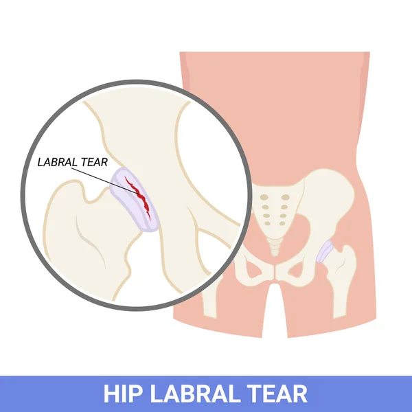 Labral Kyčle Které Trhají Zranění Porucha Lékařství — Stockový vektor