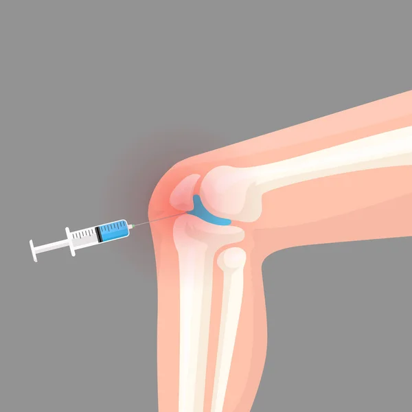 膝关节注射发炎红肿矢量图 — 图库矢量图片