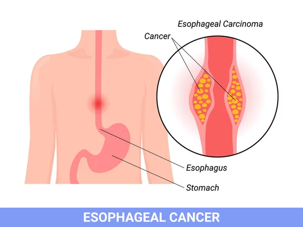 Medical Illustration Symptoms Esophageal Carcinoma — Archivo Imágenes Vectoriales