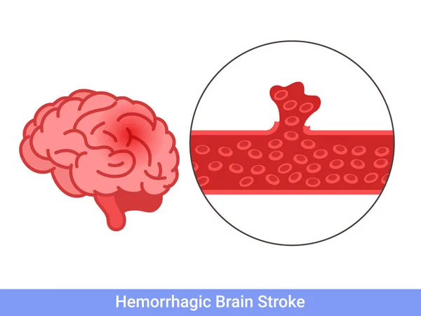 Hemorrhagic Brain Stroke Concept Apoplexy Cerebral Hemorrhage Headache Problem — Stock Vector