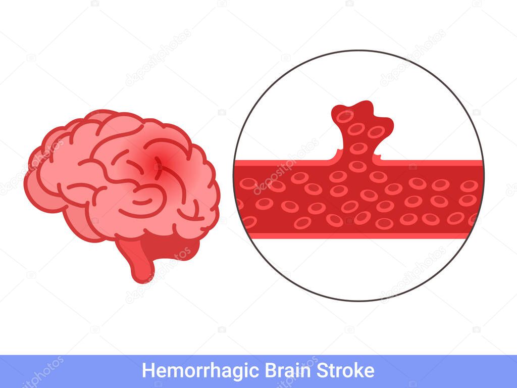 Hemorrhagic brain stroke concept. Apoplexy, cerebral hemorrhage, headache problem