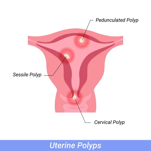Поліпи Матці Жіноча Репродуктивна Система Людські Органи Анатомії — стоковий вектор