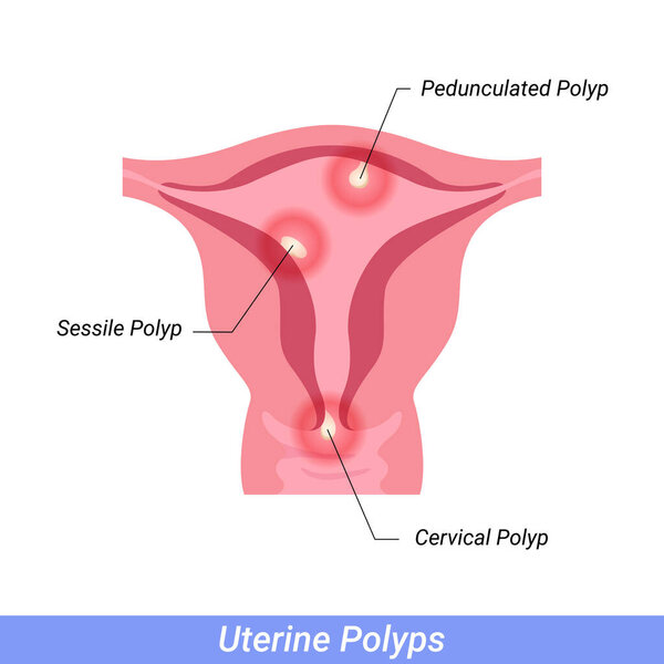Polyps in the uterus Female reproductive system. Human anatomy internal organs