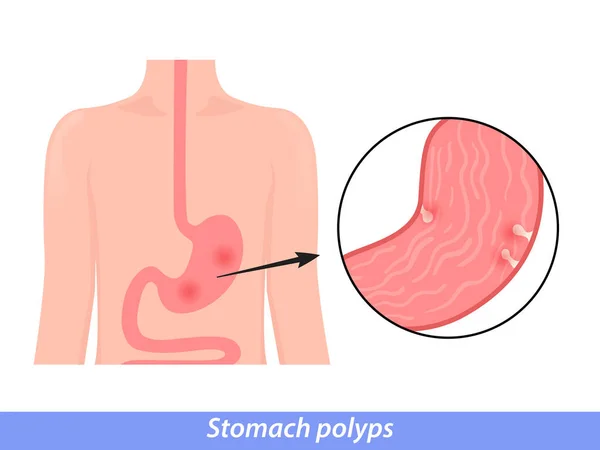 Stomach Polyps Diagnostic Removal Endoscopy Procedure Concept — Vetor de Stock