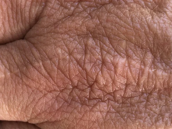 Cicatriz Close Uma Mão Madura Foto Alta Qualidade — Fotografia de Stock