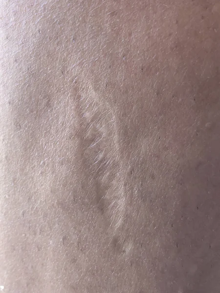 Cicatriz Cicatrizada Pele Corpo Humano Foto Alta Qualidade — Fotografia de Stock