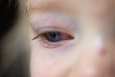 Konjonktiviti olan bir çocuğun yarı açık kırmızı gözü. Bebek ya da bebek güzel mavi gözlere sahiptir. Gözün beyaz kısmında kırmızı bir bölüm vardır. Tedavi edilmeye ihtiyaç duyar..