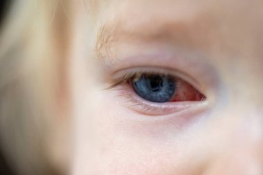 Konjonktiviti olan bir çocuğun enfekte olmuş kırmızı gözünün yakın portresi. Bebek ya da bebek güzel mavi gözlere sahiptir. Gözün beyaz kısmında kırmızı bir bölüm vardır. Tedavi edilmeye ihtiyaç duyar..