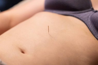 A portrait of a thin acupuncture needle between navel and sternum, put in place by an acupuncturist. This alternative medicine treatment is used for healing, stimulation, relaxing and stress relief.