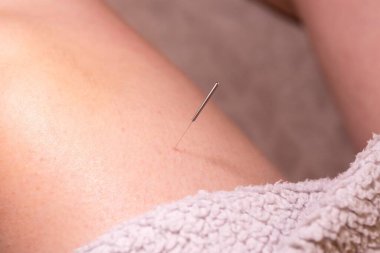 A portrait of a thin acupuncture needle placed on the upper leg, put in place by an acupuncturist. This alternative medicine treatment is used for healing, relaxing, stimulation and stress relief.