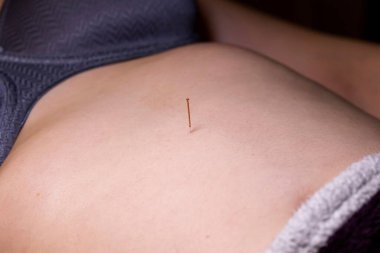 A portrait of a thin acupuncture needle between navel and sternum, put in place by an acupuncturist. This alternative medicine treatment is used for healing, relaxing, stimulation and stress relief.