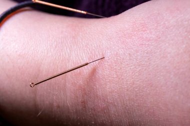 A portrait of a few thin acupuncture needles just below the wrist, put in place by an acupuncturist. This alternative medicine treatment is used for stimulation, relaxing, healing and stress relief.