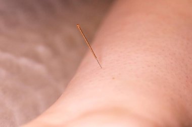 A portrait of a thin acupuncture needle a bit above the ankle, put in place by an acupuncturist. This alternative medicine treatment is used for healing, relaxing, stimulation and stress relief.