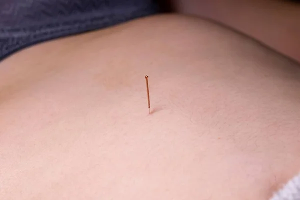 A portrait of a thin acupuncture needle between navel and sternum, put in place by an acupuncturist. This alternative medicine treatment is used for relaxing, healing, stimulation and stress relief.