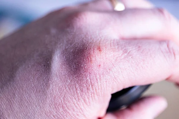 A portrait of a hand with dry skin with some painful fissures in it. The cracked skin should be treated with some moisturizing ointment or cream to prevent it from more rips.