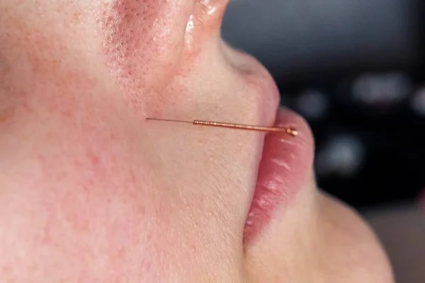 A close up portrait of a small acupuncture needle sticking in a person\'s face next to the nose, to relieve stress, heal pain or another medical condition with alternative medicine.