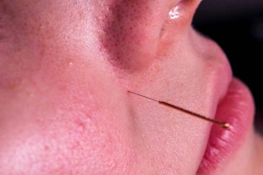 A macro portrait of a small acupuncture needle sticking in a person's face next to the nose, to relieve stress, heal pain or another medical condition with alternative medicine.